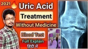 'Uric Acid Treatment In Hindi | Uric Acid Symptoms | Uric Acid Foods To Avoid | 2021'