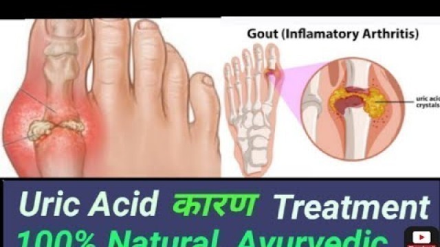 'Uric acid, causes,Treatment,Natural, Ayurvedic,Unani,Foods,100%,इलाज, जड़ से कम करें, घरेलू, यूनानी'