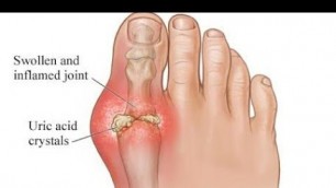 '10  FOODS CAUSING (GOUT/URIC ACID) STOP EATING THIS:    ! (HYPERURICEMIA)'