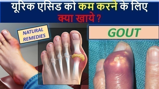 'Uric acid kya hota hai | Uric Acid Symptoms | Uric acid Treatment | Foods to avoid | Natural Remedy'