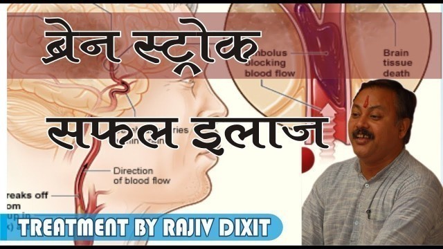 'Rajiv Dixit-TREATMENT OF BRAIN STROKE, ब्रेन स्ट्रोक का इलाज'