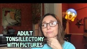 'Adult Tonsillectomy with Tips, Food, and Pictures'