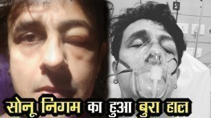 'Sonu Nigam hospitalised due to sea food allergy, shares photos of swollen face !'