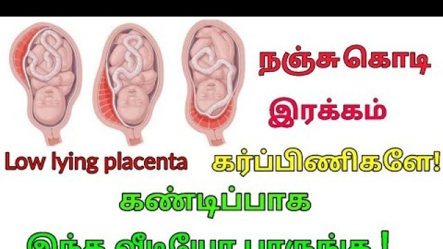 'நஞ்சு கொடி இரக்கம் | Nanju Kodi Irakkam in Tamil |   Placenta Position During Pregnancy.'