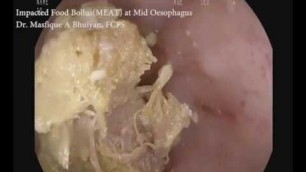 '#food_stuck #meat_stuck #oesophagus Food bolus(obstructed meat)stuck at oesophagus'