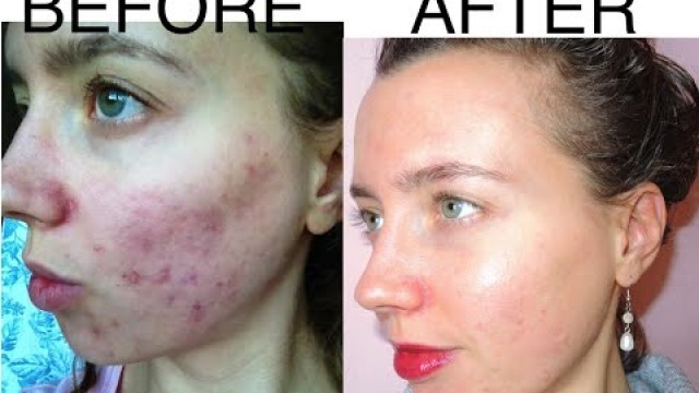 'BEFORE AND AFTER RAW VEGANISM PICTURES OF MY SKIN'